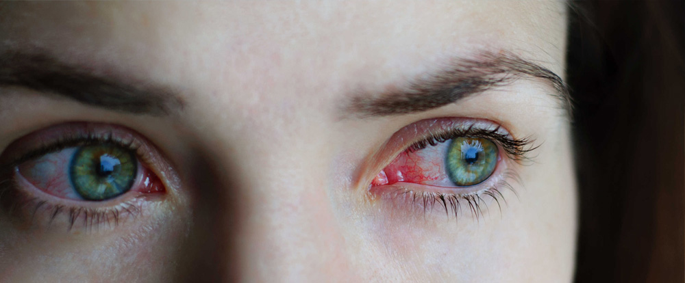 Conjuntivitis Alérgica